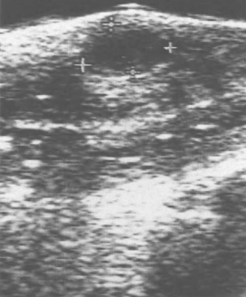 Immagine ecografica di un ematoma incapsulato sottocute (frecce) dopo la rottura del pene