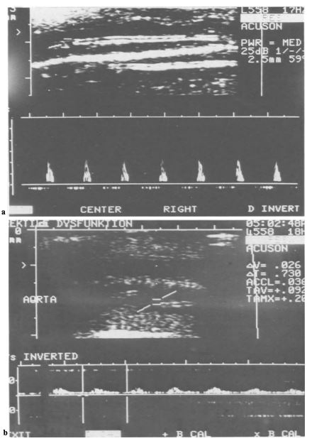 Conventional duplex sonography