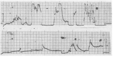 Normal tumescences during REM phases