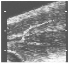 Arterialisation of a cavernous artery