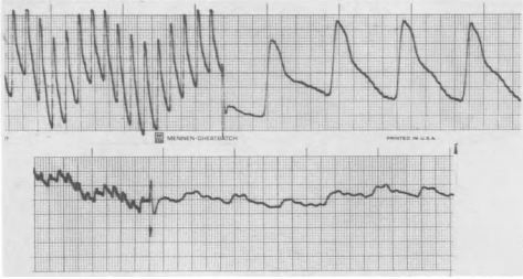 Plethysmogram of the penis