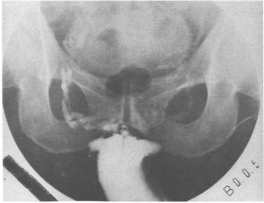 Röntgenaufnahme von 65-jähriger Patient mit erektiler Dysfunktion nach transurethraler Prostataresektion