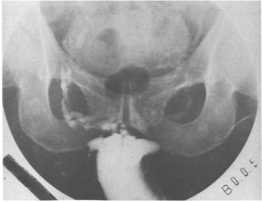 Radiographie d'un patient de 65 ans souffrant de dysfonction érectile après résection transurétrale de la prostate