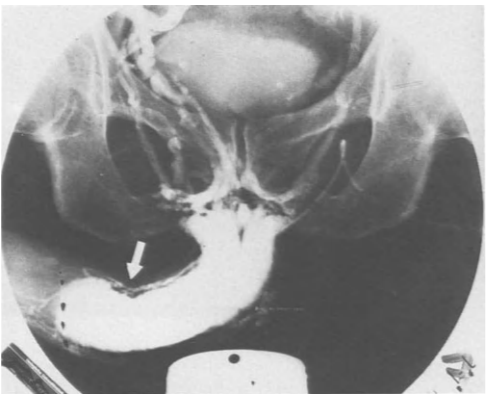 Pharmacocavernosogram of a patient with induratio penis plastica and erectile dysfunction