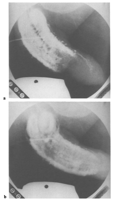 Kunstmatig cavernosogram in het geval van een hoogwaardige urethrale structuur in het micturitie cystourethrogram