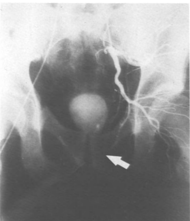 Selective visualization of the internal iliac artery without staining of the penile vessels