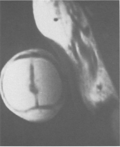 Connective tissue structures in the area of the corpus cavernosum septum