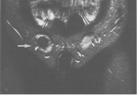 Kernspintomographische Aufnahme mit Maldescensus testis