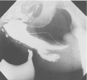 Cavernosography in fresh penile fracture with extravasation in the anterior third of the penis